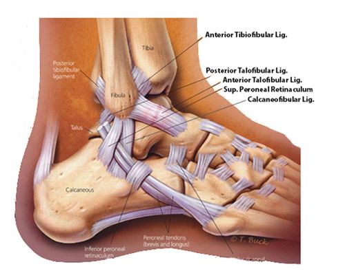 Ankle Ligament Tears